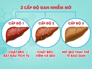 cấp độ của gan nhiễm mỡ