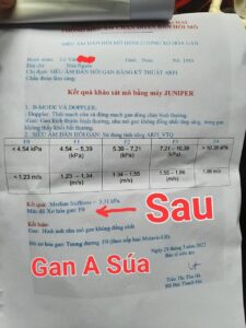 gan a súa - khỏi xơ gan