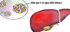 VIÊM GAN C CÓ NGUY HIỂM KHÔNG