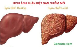 phân biệt gan nhiễm mỡ