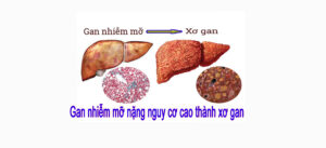 gan nhiễm mỡ nặng dẫn đến xơ gan