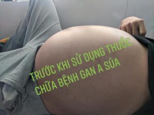 trước dùng gan a súa - xơ gan cổ trướng