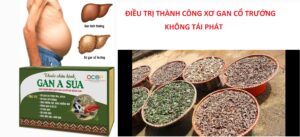 chữa khỏi xơ gan cổ trướng 3 năm không tái phát