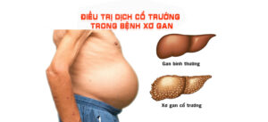 điều trị cổ trướng do xơ gan