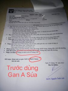 gan a súa xơ gan cổ trướng