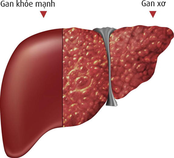 khi gan bị xơ hóa dần mất đi chức năng hoạt động