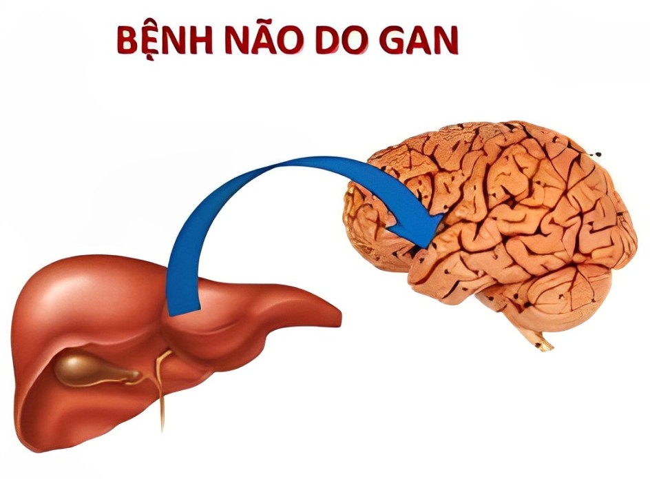 bệnh não gan