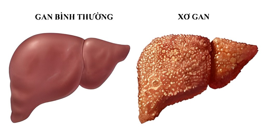 gan bình thường và xơ gan