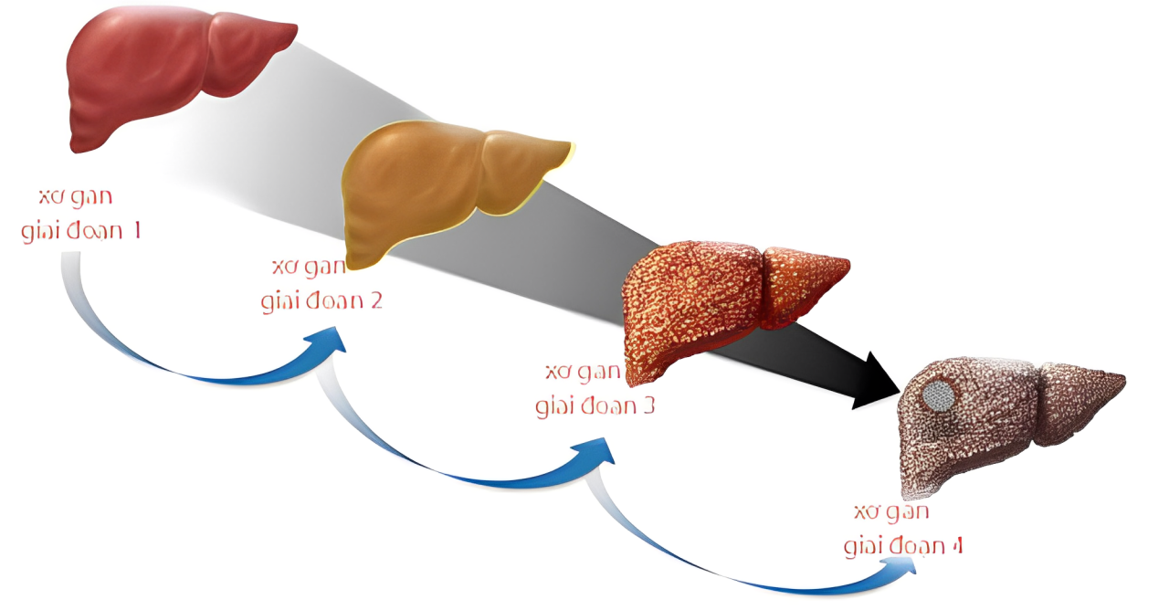 các giai đoạn của bệnh xơ gan