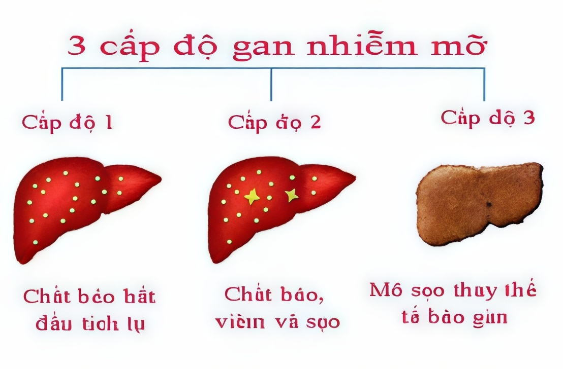 cấp độ gan nhiễm mỡ
