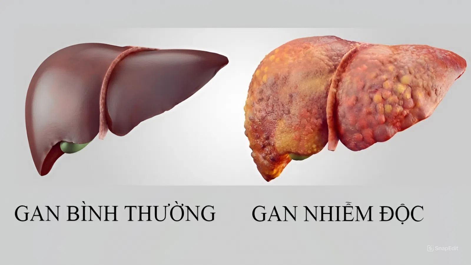 nhiễm độc gan