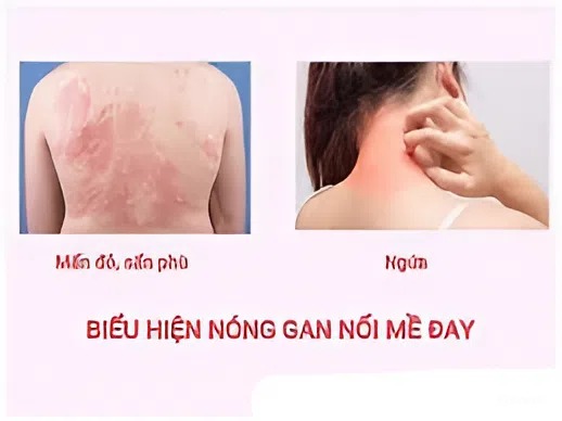 biểu hiện nóng gan nổi mề đay