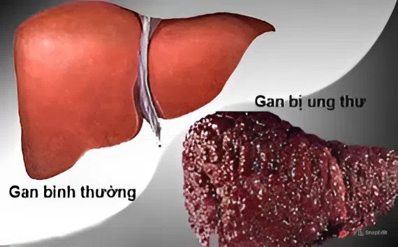 TÁC HẠI ĐẾN GAN