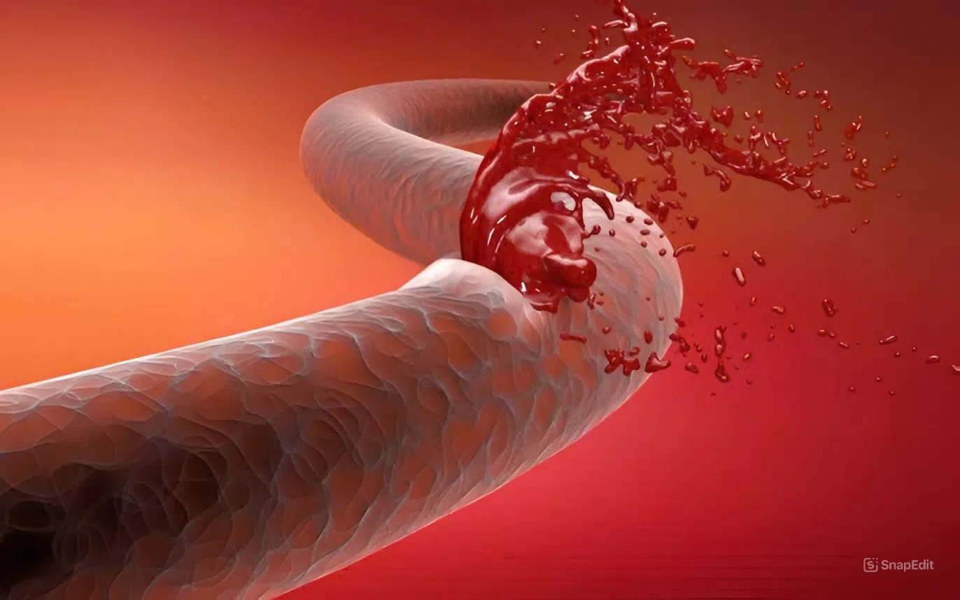 VỠ TĨNH MẠCH THỰC QUẢN