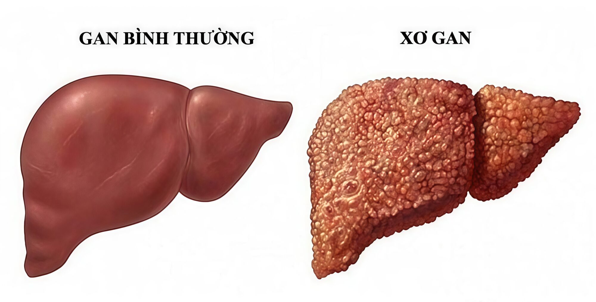 hội chứng 3 giảm trong xơ gan